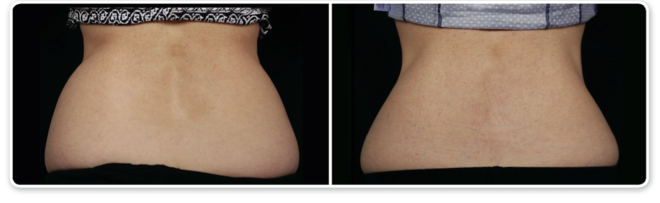 coolsculpting-avant-apres, maigrir sans chirurgie avec le dr Jauffret, médecine esthétique à Marseille