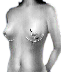 Hypertrophie mammaire - Dr Jauffret, chirurgien plasticien à Marseille