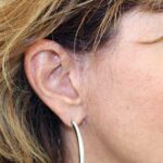 Minilifting du visage à Marseille - Dr Jauffret, chirurgien plasticien